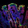 Thumbnail for dataset Figure7DE_EGFR-E-Cadherin_adenoma